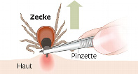 Entfernung von Zecken